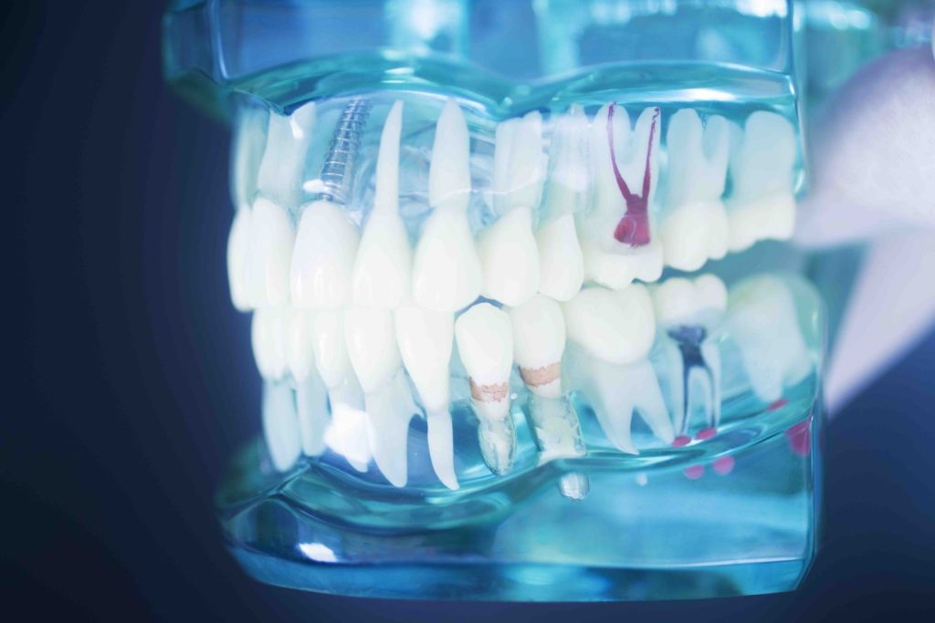 Implantologia Dentale e Protesi: Una Guida Completa Sulle Riabilitazioni Implantoprotesiche 1 Impianto dentale e protesi