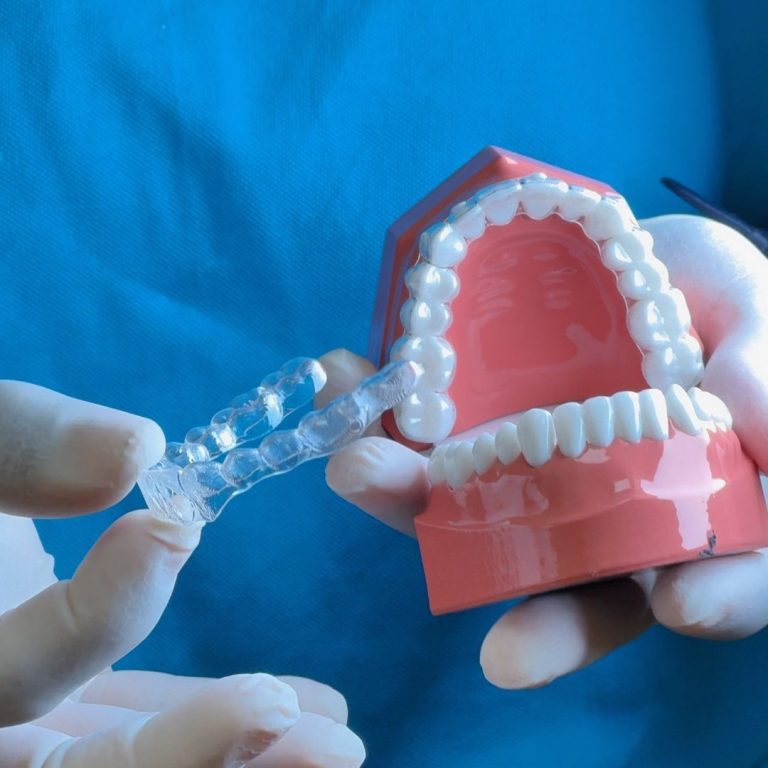 Blog 2 come pulire le mascherine dei denti, apparecchio trasparente a Monza e Muggiò