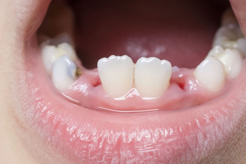 Quando iniziano a spuntare i dentini 1 Quando iniziano a spuntare i dentini