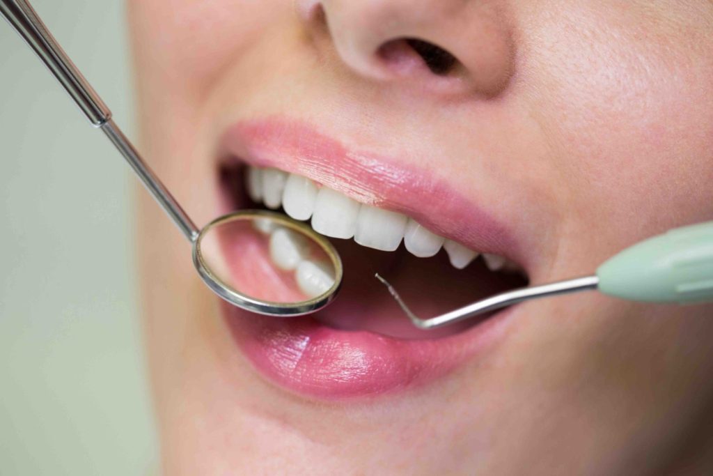Limare i denti per le faccette: è davvero necessario? 1 Limare i denti per le faccette