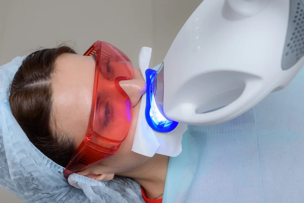 Quanto dura l’effetto dello sbiancamento dei denti